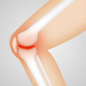 Ways to Fix Anterior Knee Pain
